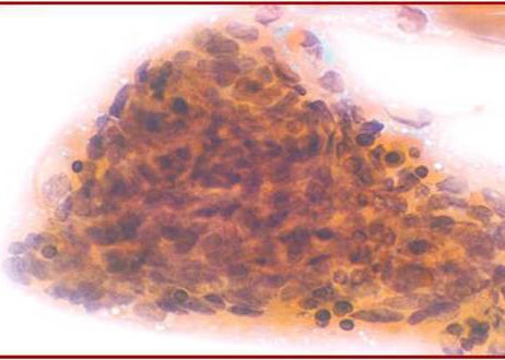 Cells with nuclear atypia