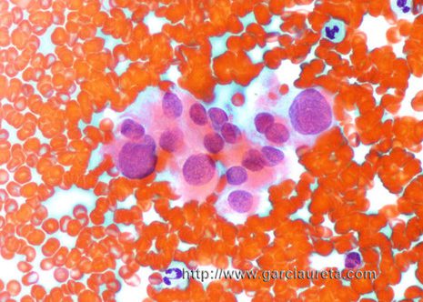 Núcleos pleomórficos con tamaño variabél de carcinoma papilar. (tinción Pap)
