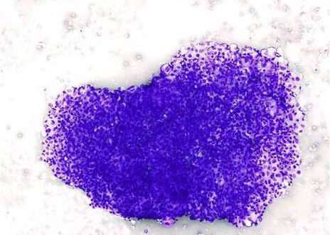 Urine washing: three-dimensional cell group. A large staghorn cluster of urothelial cells is infiltrated by a few acute and chronic inflammatory cells. The urothelial cell nuclei are round to oval and contain thickened nuclear rims although the chromatin pattern is hyperchromatic.