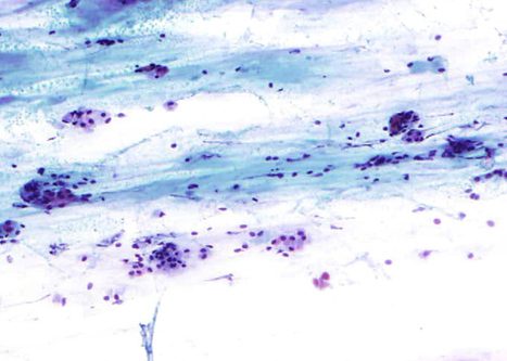 Background mucus stained pole pink o green is a useful indicator of sampling from the cervix.