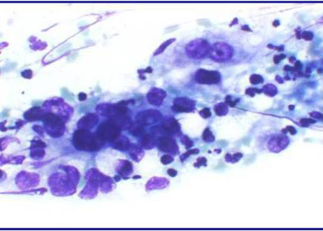 Epithelia cells showing atypia.