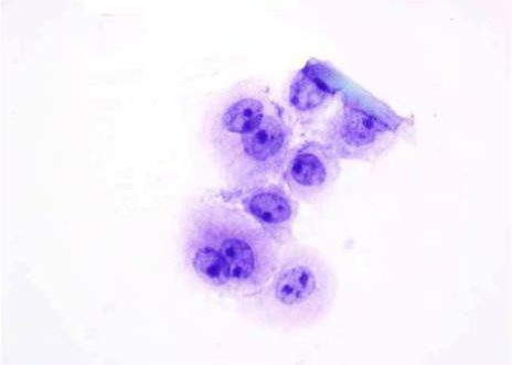 Urine voided: high grade urothelial carcinoma. The malignant cell nuclei are large and the nuclear membranes show focal thickening. Several of the nuclei show multiple prominent nucleoli.