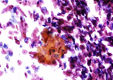 Anucleated squames desquemated from the superficial layers of keratinized-hyperkeratotic- squamous epithelium.