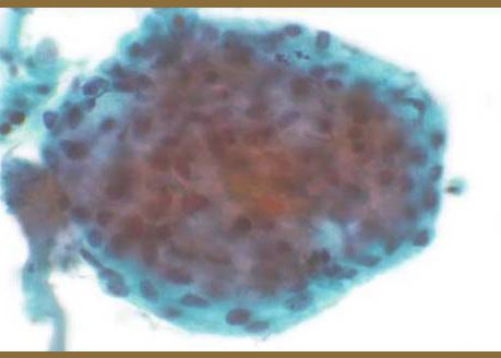 Thin-Prep Poroid cells.