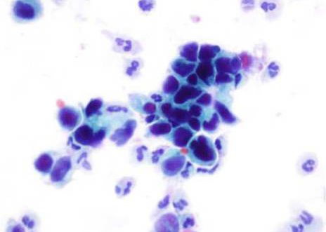 Orina: Carcinoma urotelial de alto grado. As células uroteliais maliñas varían en tamaño e forma e presentan graos variables de dexeneración.