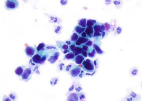 Urine voided: high-grade urothelial carcinoma. The malignant urothelial cells vary in size and shape and exhibit degrees of degeneration.