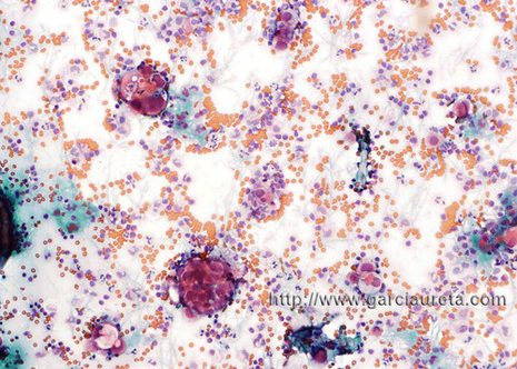 At low-magnification this specimen shws increased cellularity of a large population of single mesothelial cells and occasional round tightly cohesive clusters (Pap stain)