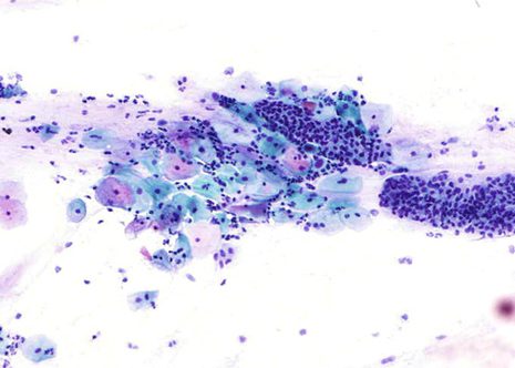 A good-quality sample consists of well-displayered cells with representative sampling of both squamous and endocervical or metaplastic epithelium.