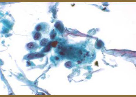 Cuticular cells with moderate cytoplasm.Cuticular cells with moderate cytoplasm.