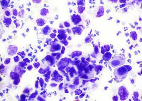 Urine voided: high-grade urothelial carcinoma. The malignant urothelial cells contain a thin rim of homogeneous cytoplasm. There is an obsence of cytoplasmic vacuoles.