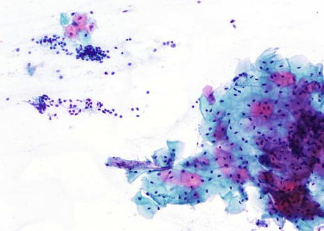 Squamous cells and tall columnar cells with eccentricelly located nuclei and abundant cytoplasm.