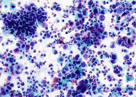 Carcinoma urotelial pobremente diferenciado (grao III). Pleomorfismo nuclear e hipercromasia con relación núcleo citoplasma alta.