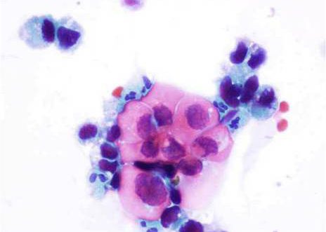 Group of malignant cells from high grade (III) urothelial carcinoma of bladder. The nuclei display an irregular chromatin pattern and contain nucleoli. The cytoplasm is focally eosinophilic.