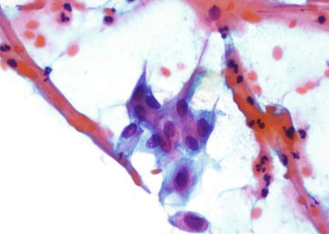 Inmature squamous metaplasie showing spiderly cytoplasmic projections due to forceful removal of the cells from the mucosa.