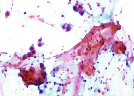 Inmature squamous metaplasia cells liying sinply and in a sheet with relatively large nuclei indistint cell corders and homogeneous or fine vacuolated cytoplasm.