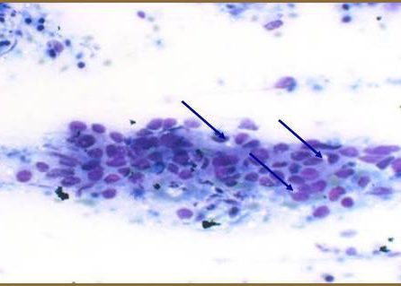 Presenza de luces intracitoplasmáticos.