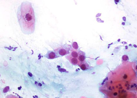 Immature squamous metaplasia cells liying simple and in a sheet.