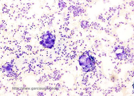 This peritoneal fluid shows papillary clusters of varying sizes (MGG stain)