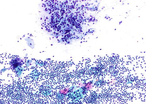 Smear pattern in non-specific cervicitis with numerous polymorphs.