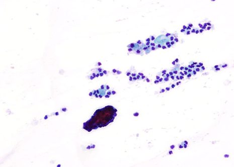 Mostra de cervicitis non específica con abundantes polimorfonucleares.