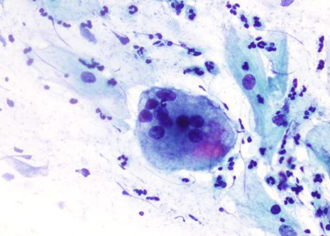 Multinucleated macrophages or giant cells are non-specific finding especially after the menopause.