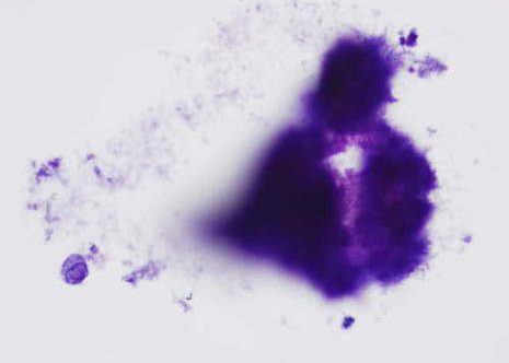 Actinomyces organisms presenting in colonies of filamentous organisms with no significant inflammation.