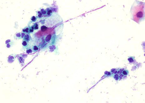 Budding yeasts and pseudohyphae of Candida Albicans in a lightly inflamed cervical smear.
