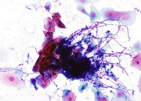 Candida hyphae forming a tangled mass overlying a plaque of squamous cells. Some spores between the hyphae.