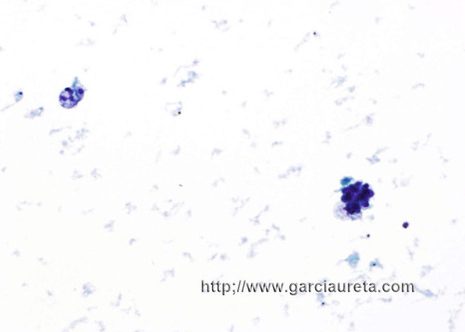 Very hypocellular specimens containing only rare groups of malignant cells (Thin-Prep, Pap stain)