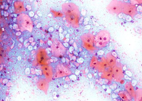 Perinuclear halo in a superficial cell forming a narrow zone of pallor around the nucleus. This is a non- specific inflammatory response most often seen in Trichomonas vaginalis infection.