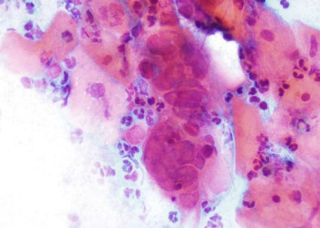 Bizarre cells in a smear with Herpes genitalis infectión.