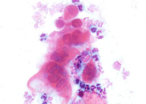 Herpes Simplex Virus changes in cervical epithelial cells.