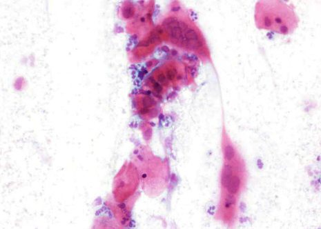 Bizarre cells in a smear with Herpes genitalis infectión.