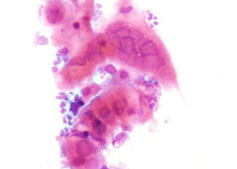 Initielly there is swelling of the nuclei followed by degeneration of chromatin leading to a ground glass pattern.