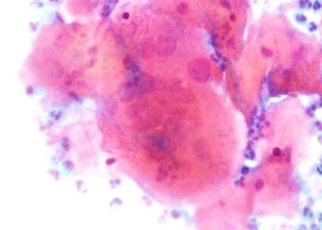 Herpes Genitalis infection. Multinucleation is a prominent feature.