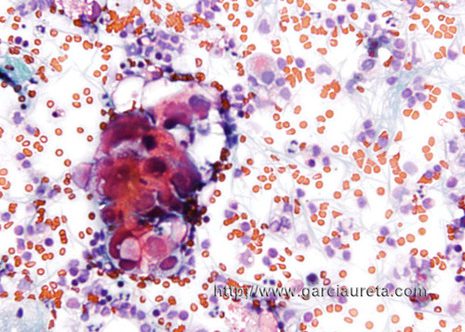 A cluster of cells with diverse nuclear diameters.