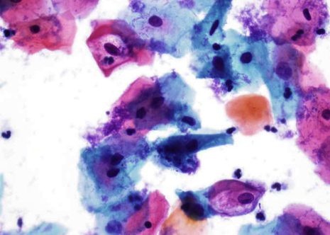 Condylomatous change in mature squamous epithelium. Irregularity in nuclear size and shape and conspicuous nuclear halos.