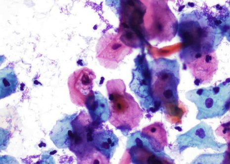 Koilocytes showing bordeline nuclear changes in which. The nuclei appear near normal with minimal enlargement and change in chromatin.