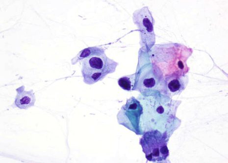 Koilocytotic cells. Large perinuclear halo. Dense outer zone of the cytolplasm an enlarged nucleus with dense hyperchromatic nuclear chromatin.