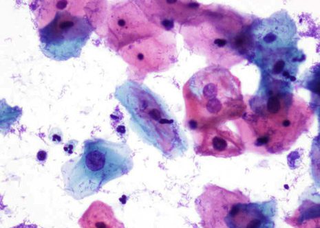 Koilocytotic atypia. Cervical smears with LSIL showing cells with vacuolization of the cytoplasm and slight atypia of the nuclei.