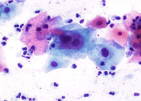 L-SIL. Cells of squamous type with slightly enlarged nuclei and some hyperchromasia.