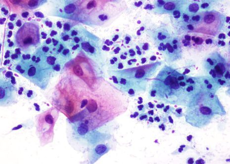 Cells of squamous type with slightly enlarged nuclei. The nuclear chromatin is finely granular and very slightly.