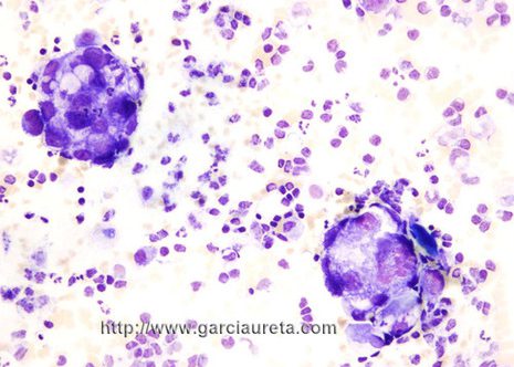 Cellular specimen with two rounded cluster of malignant cells and the background contained small rounded lymphocytes.