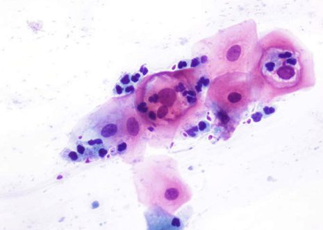 HPV infection low grade squamous intraepithelial neoplasm LSIL changes.