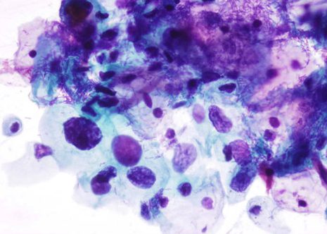 H-SIL. Cells very in size and shape. Nuclei are round to oval and irregular in shape. Nuclear chromatin is in part finely, in part coarsely granular and moderately hyperchromatic. Incrased nucleocytoplasmic ratio.