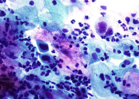 H-SIL. The nuclei of the cells are hyperchromatic have irregular outlines and show complex folding.