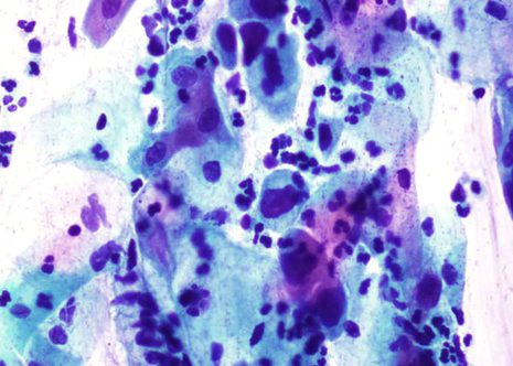 H-SIL. Células e núcleos con formas irregulares, cromatina granular, e núcleos hipercromáticos.