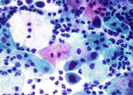 Cells very in size and shape. Nuclei are round to oval and irregular in shape. Nuclear chromatin is coarsely granular and hyperchromatic. Incrased nucleocytoplasmic ratio.