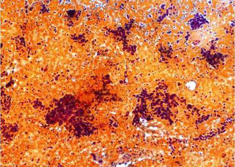 Carcinoma Escamoso. Acúmulos de células maliñas, sangue e restos necróticos.