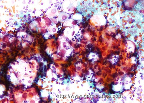A large cluster. These cells show marked nuclear pleomorphism.